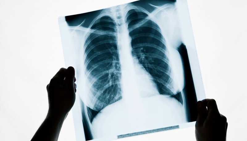 рентгеновский снимок легких